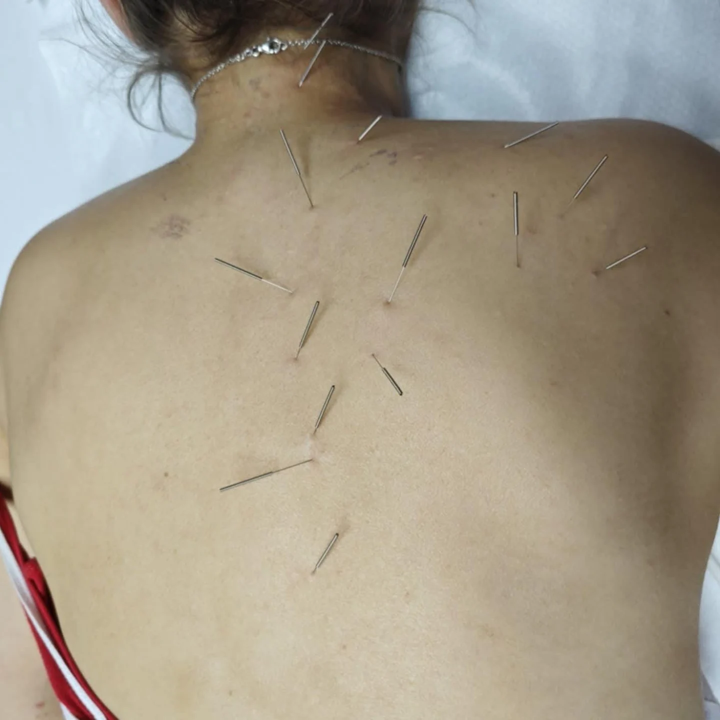 Fizioterapijski tretman - dry needling